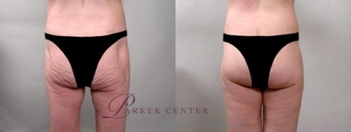 Body Lift Case 920 Before & After View #1 | Paramus, NJ | Parker Center for Plastic Surgery