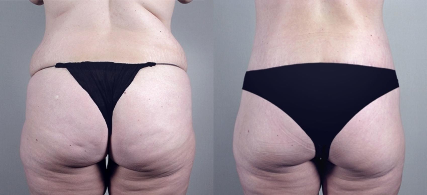 Supplies for Body Contour Surgery: Abdominoplasty, Body Lift, Liposuction