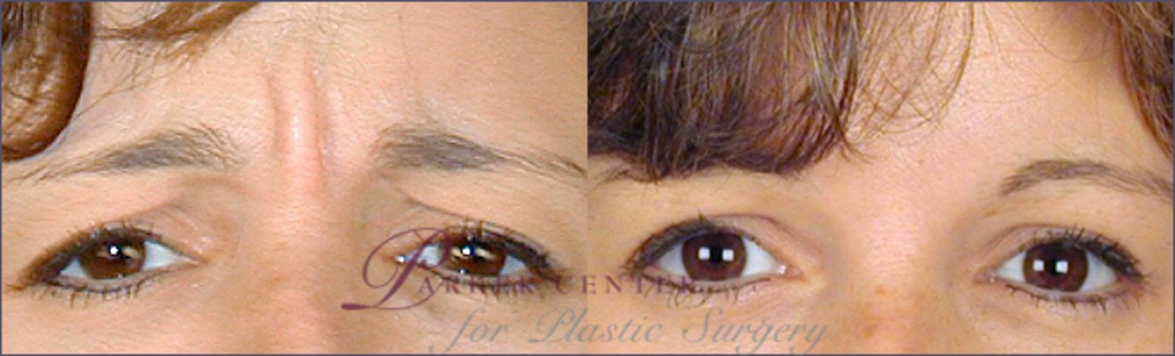 BOTOX® & Jeuveau® Case 268 Before & After View #1 | Paramus, NJ | Parker Center for Plastic Surgery