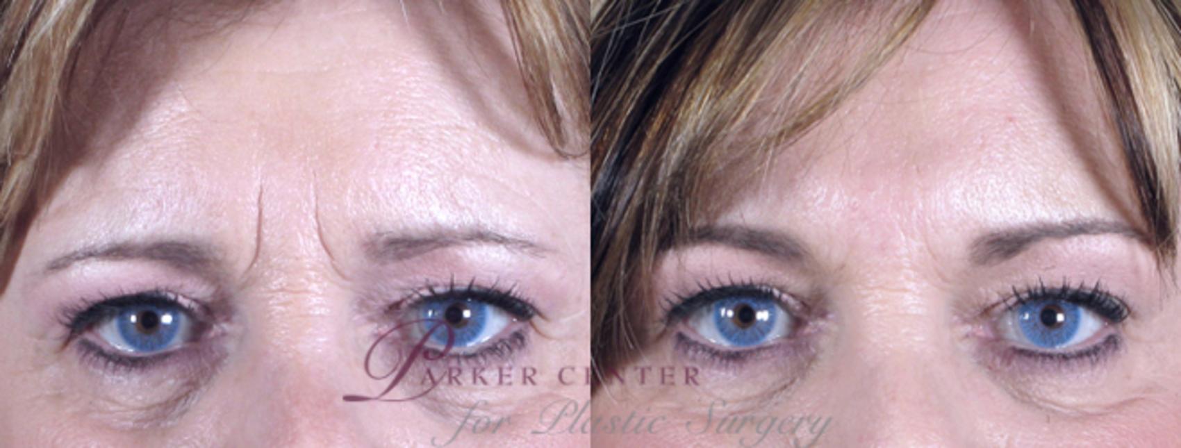 BOTOX® & Jeuveau® Case 271 Before & After View #1 | Paramus, NJ | Parker Center for Plastic Surgery