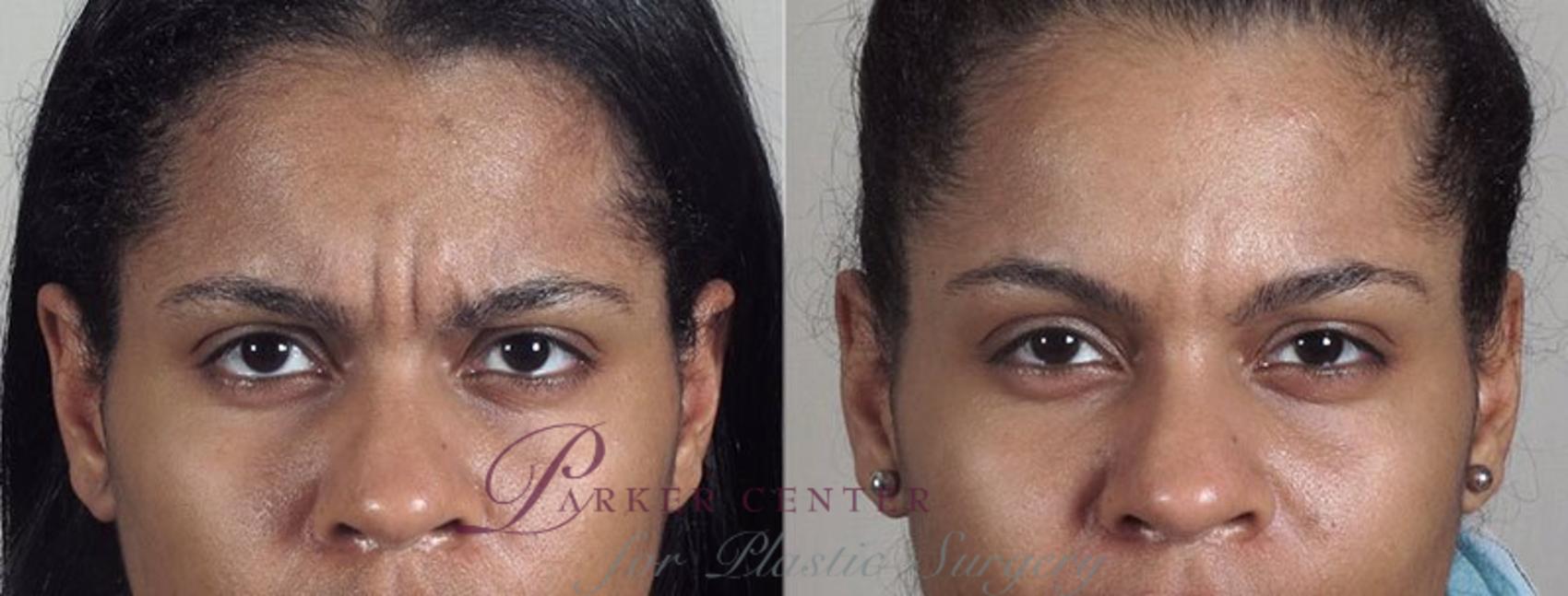 BOTOX® & Jeuveau® Case 288 Before & After View #1 | Paramus, NJ | Parker Center for Plastic Surgery