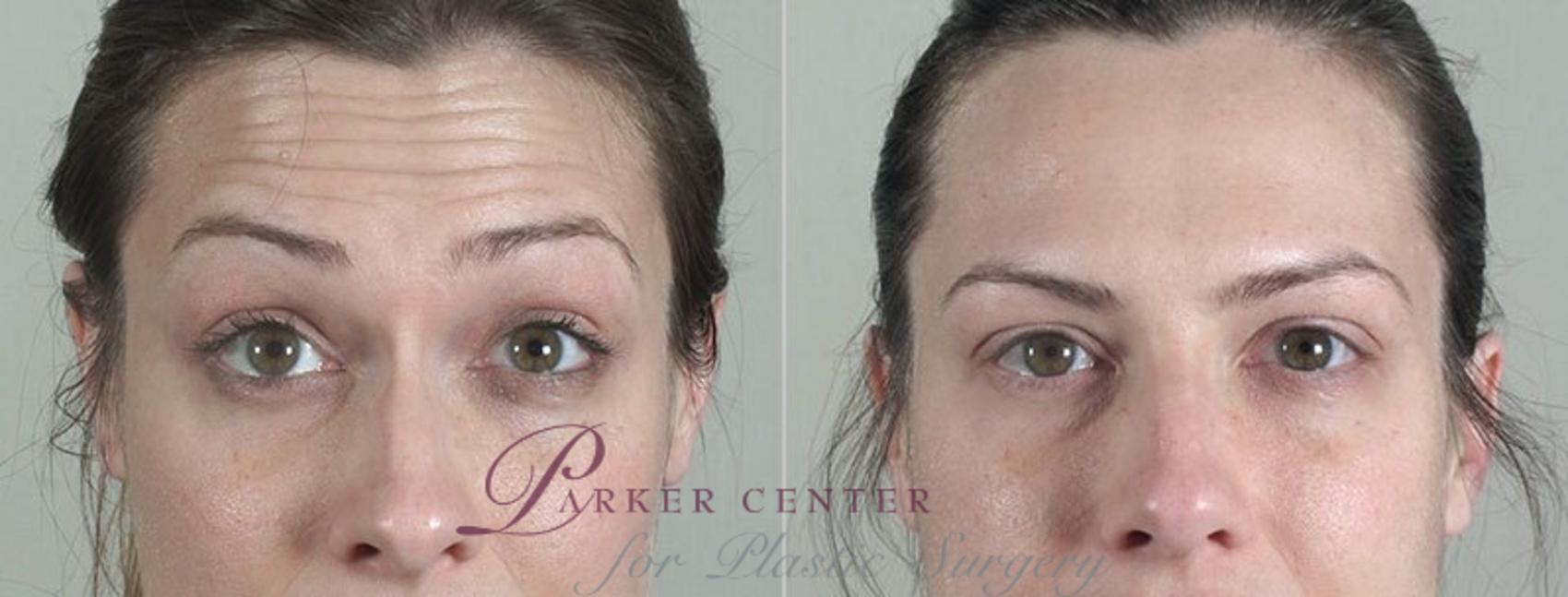 BOTOX® & Jeuveau® Case 289 Before & After View #1 | Paramus, NJ | Parker Center for Plastic Surgery