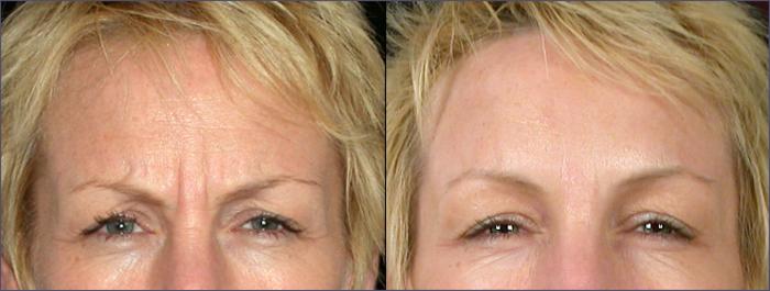 BOTOX® & Jeuveau® Case 267 Before & After View #1 | Paramus, New Jersey | Parker Center for Plastic Surgery