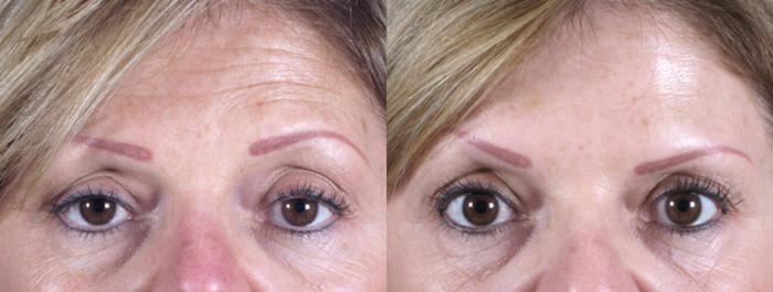 BOTOX® & Jeuveau® Case 270 Before & After View #1 | Paramus, New Jersey | Parker Center for Plastic Surgery