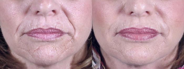 BOTOX® & Jeuveau® Case 271 Before & After View #2 | Paramus, New Jersey | Parker Center for Plastic Surgery