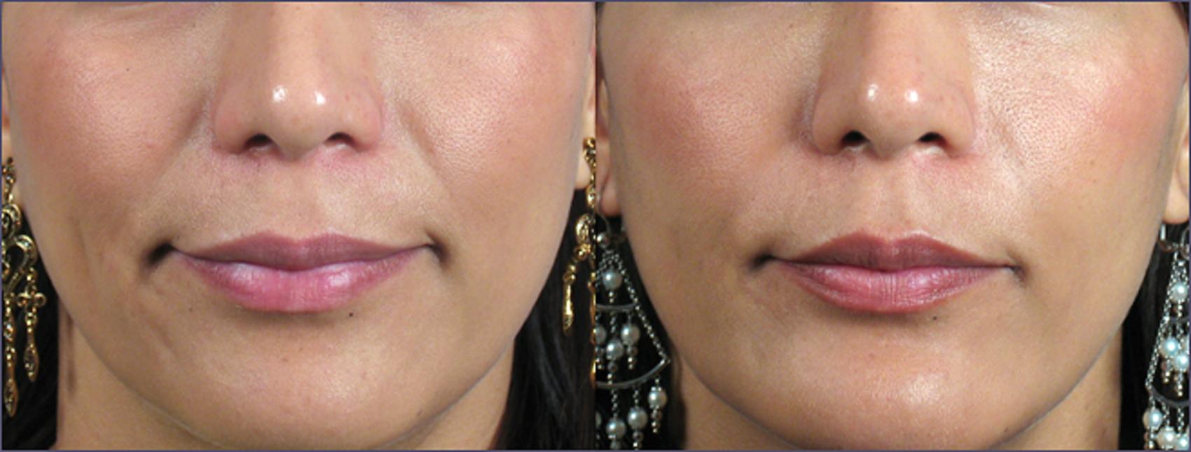 BOTOX® & Jeuveau® Case 274 Before & After View #1 | Paramus, New Jersey | Parker Center for Plastic Surgery