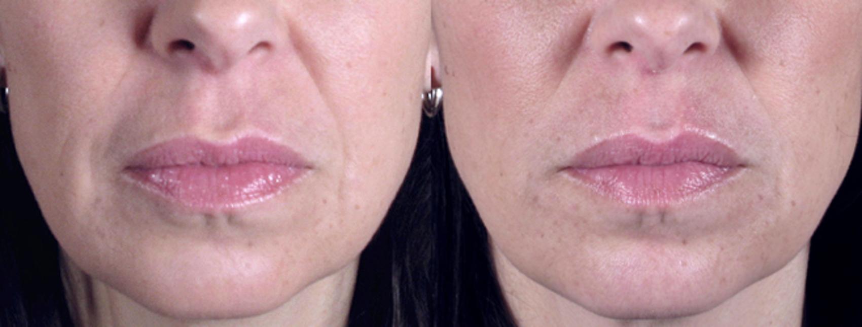 BOTOX® & Jeuveau® Case 275 Before & After View #1 | Paramus, New Jersey | Parker Center for Plastic Surgery