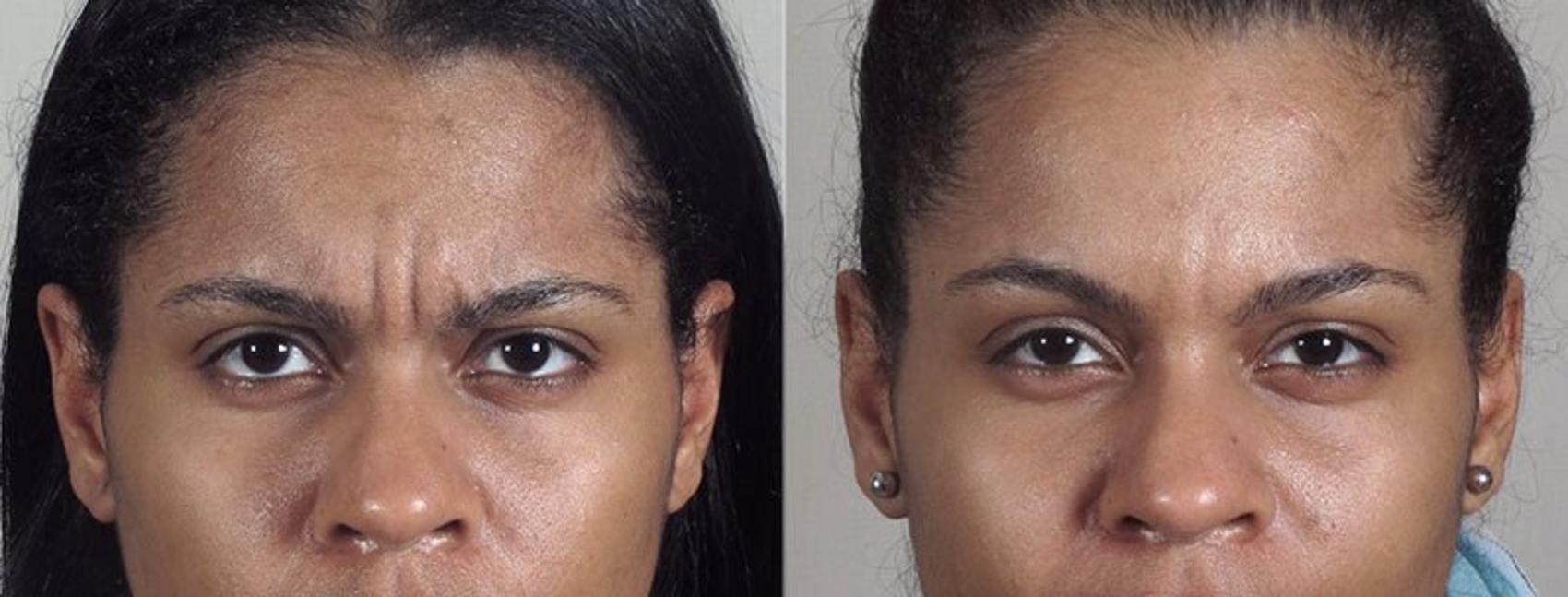 BOTOX® & Jeuveau® Case 288 Before & After View #1 | Paramus, New Jersey | Parker Center for Plastic Surgery