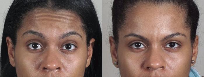 BOTOX® & Jeuveau® Case 288 Before & After View #2 | Paramus, New Jersey | Parker Center for Plastic Surgery