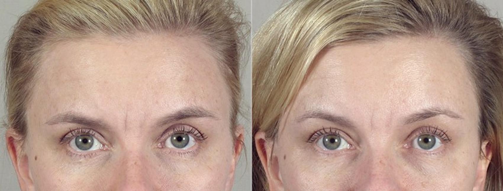 BOTOX® & Jeuveau® Case 294 Before & After View #1 | Paramus, New Jersey | Parker Center for Plastic Surgery