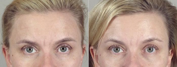 BOTOX® & Jeuveau® Case 294 Before & After View #1 | Paramus, New Jersey | Parker Center for Plastic Surgery