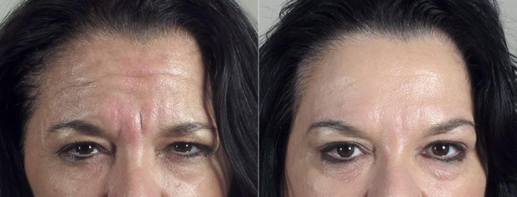 BOTOX® & Jeuveau® Case 296 Before & After View #1 | Paramus, New Jersey | Parker Center for Plastic Surgery