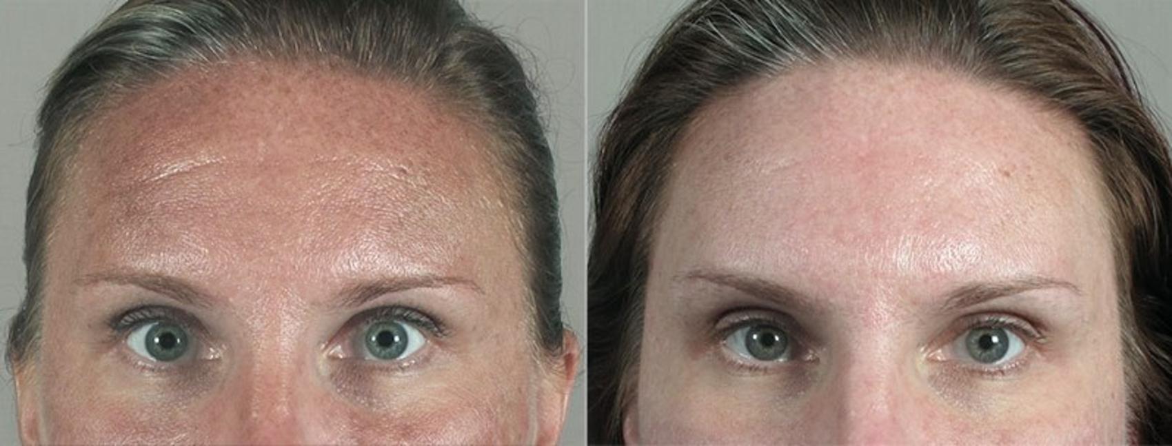 BOTOX® & Jeuveau® Case 297 Before & After View #1 | Paramus, New Jersey | Parker Center for Plastic Surgery