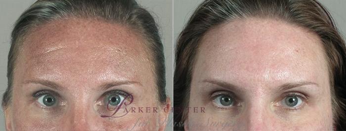Nonsurgical Face Procedures Case 297 Before & After View #1 | Paramus, New Jersey | Parker Center for Plastic Surgery