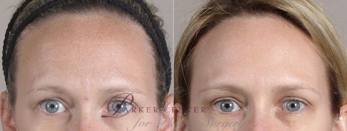 Nonsurgical Face Procedures Case 300 Before & After View #1 | Paramus, New Jersey | Parker Center for Plastic Surgery