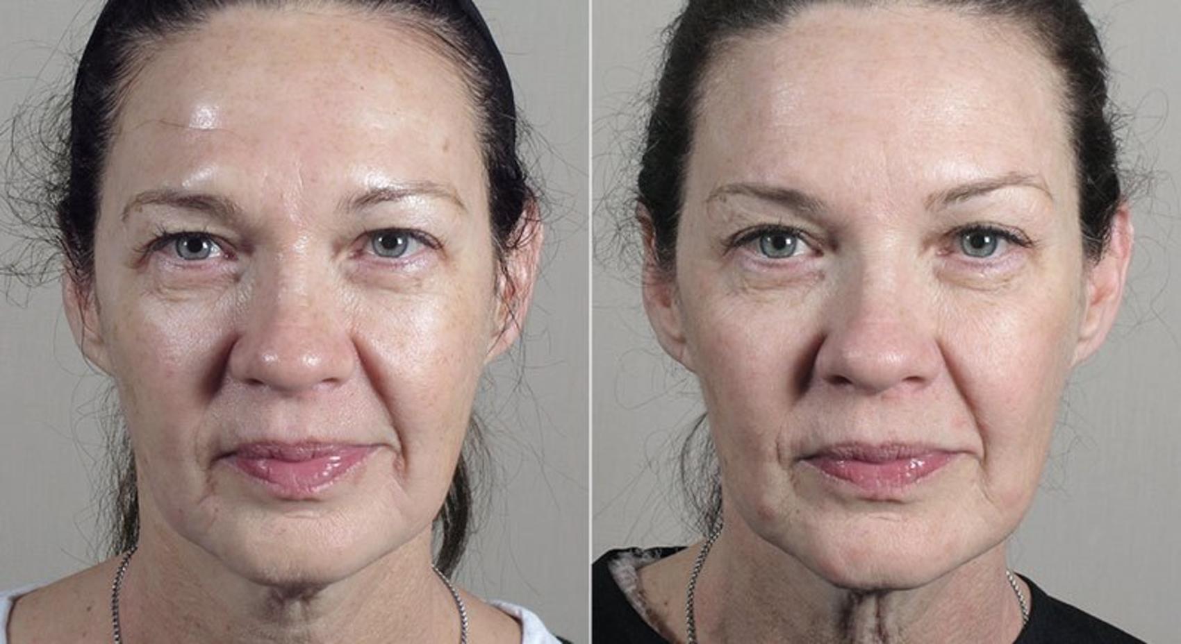 BOTOX® & Jeuveau® Case 322 Before & After View #1 | Paramus, New Jersey | Parker Center for Plastic Surgery