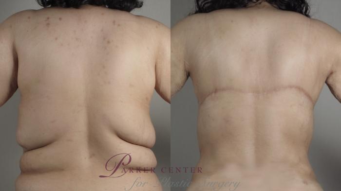 Bra Line Back Lift Before & After Photos Patient 1001680