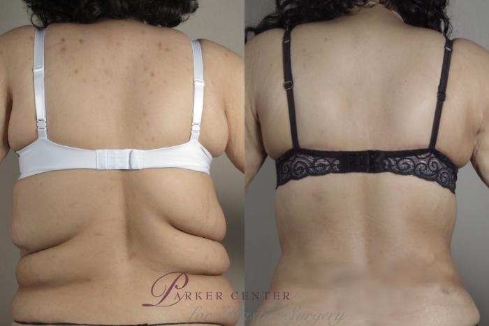 Bra Line Back Lift Before & After Photo Gallery