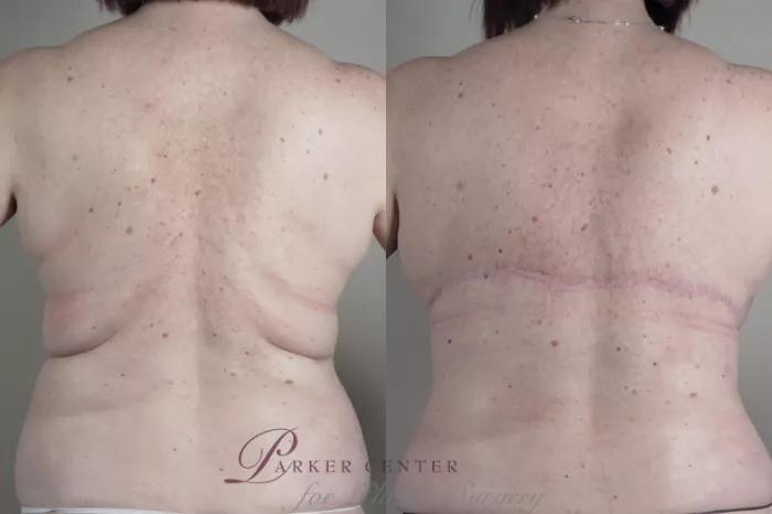 Bra Line Back Lift Before and After Pictures Case 1314, Paramus, NJ