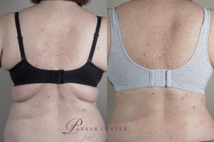 Bra Line Back Lift Before and After Pictures Case 1024, Paramus, NJ