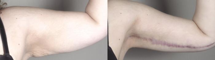 Bra Line Back Lift Case 1315 Before & After arms 2 | Paramus, New Jersey | Parker Center for Plastic Surgery