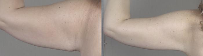 Bra Line Back Lift Case 1315 Before & After back arm 1 | Paramus, New Jersey | Parker Center for Plastic Surgery