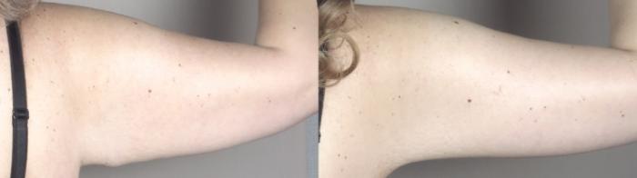 Bra Line Back Lift Case 1315 Before & After back arm 2 | Paramus, New Jersey | Parker Center for Plastic Surgery