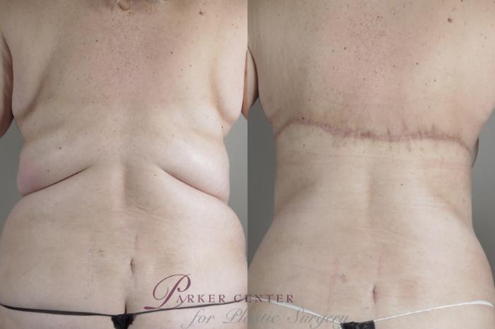 Bra Line Back Lift Before and After Pictures Case 1315, Paramus, NJ