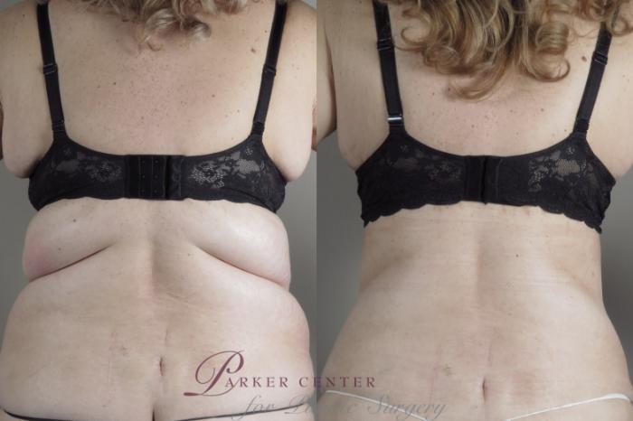 Bra Line Back Lift Before and After Pictures Case 1314