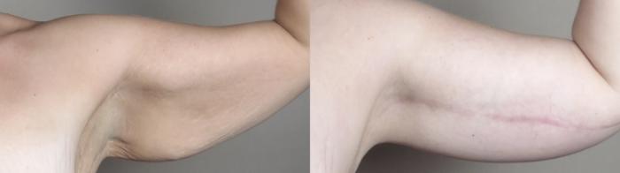 Bra Line Back Lift Case 1318 Before & After arms2 | Paramus, New Jersey | Parker Center for Plastic Surgery