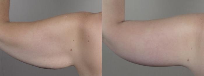 Bra Line Back Lift Case 1318 Before & After back 1 | Paramus, New Jersey | Parker Center for Plastic Surgery