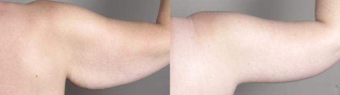 Bra Line Back Lift Case 1318 Before & After back 2 | Paramus, New Jersey | Parker Center for Plastic Surgery