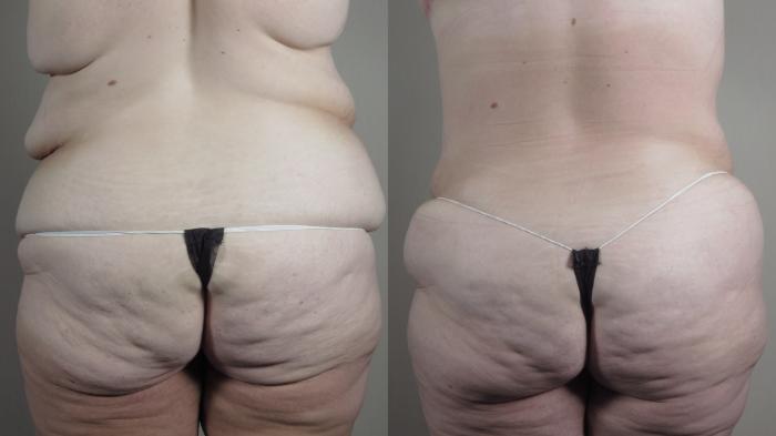 Bra Line Back Lift Case 1318 Before & After back view | Paramus, New Jersey | Parker Center for Plastic Surgery