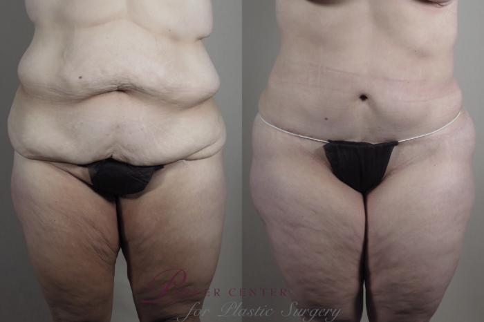 Bra line CoolSculpting Before & After Patient 06