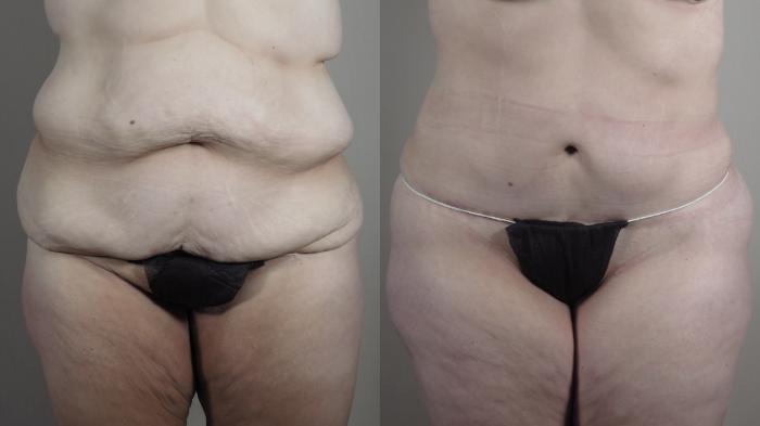 Bra Line Back Lift Case 1318 Before & After front view | Paramus, New Jersey | Parker Center for Plastic Surgery