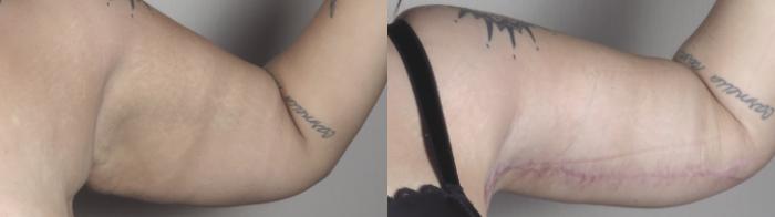 Bra Line Back Lift Case 1335 Before & After arm | Paramus, New Jersey | Parker Center for Plastic Surgery