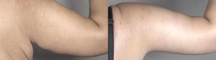 Bra Line Back Lift Case 1335 Before & After back arms | Paramus, New Jersey | Parker Center for Plastic Surgery