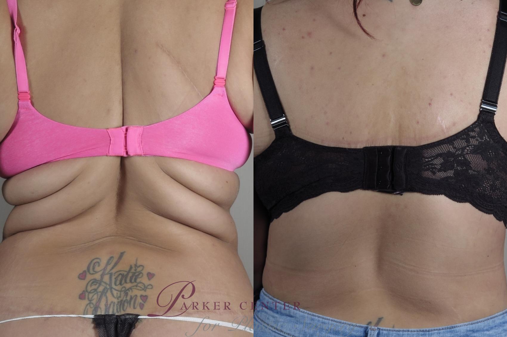Body Contouring with Bra line Back Lift