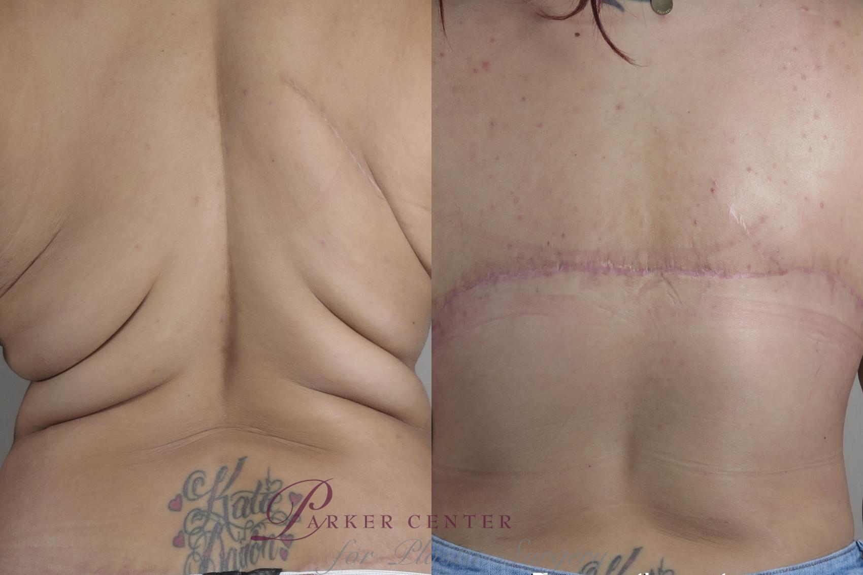 Bra Line Back Lift Case 1335 Before & After back view 2 braless  | Paramus, New Jersey | Parker Center for Plastic Surgery