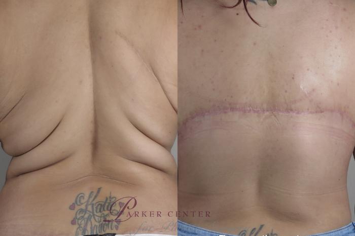 Bra Line Back Lift Case 1335 Before & After back view 2 braless  | Paramus, NJ | Parker Center for Plastic Surgery