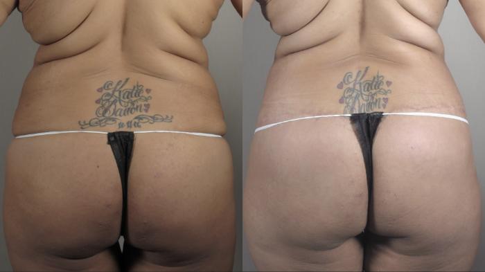 Bra Line Back Lift Case 1335 Before & After back3 | Paramus, New Jersey | Parker Center for Plastic Surgery