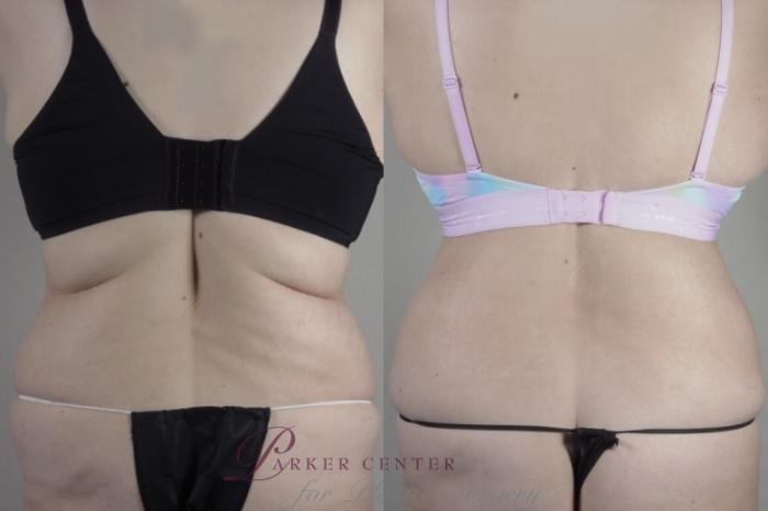 Bra Line Back Lift Case 1375 Before & After back with bra  | Paramus, NJ | Parker Center for Plastic Surgery