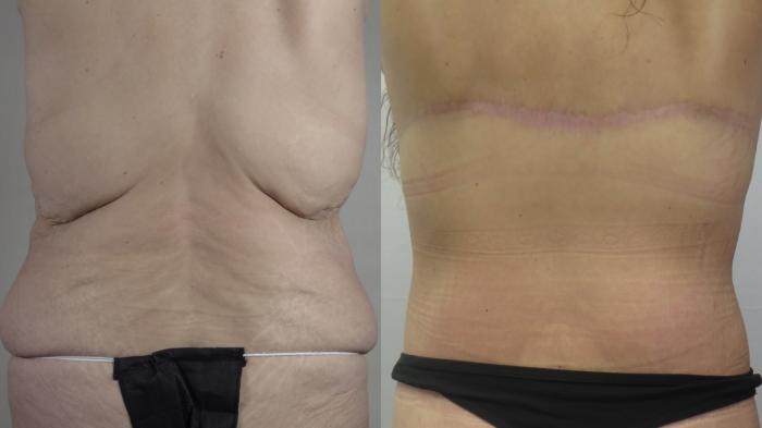 Bra Line Back Lift Case 1583 Before & After back 2 | Paramus, New Jersey | Parker Center for Plastic Surgery