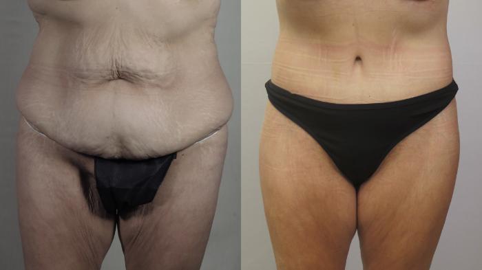 Bra Line Back Lift Case 1583 Before & After Front | Paramus, New Jersey | Parker Center for Plastic Surgery