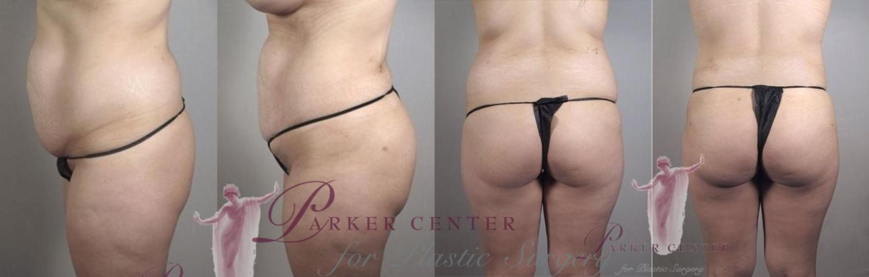 Brazilian Butt Lift Case 1152 Before & After Front | Paramus, NJ | Parker Center for Plastic Surgery