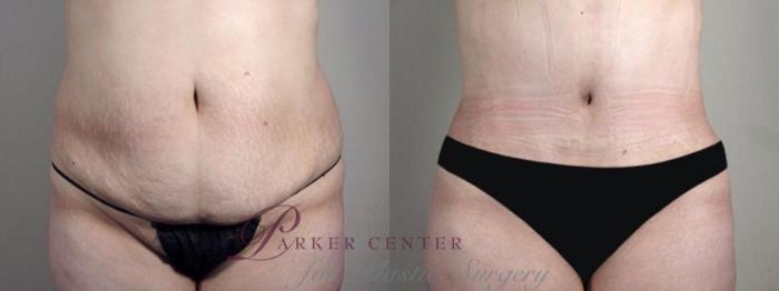 Fat Injection Case 1339 Before & After Front | Paramus, NJ | Parker Center for Plastic Surgery
