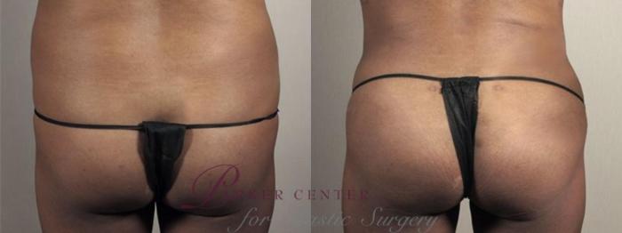 Brazilian Butt Lift Case 1340 Before & After Back | Paramus, NJ | Parker Center for Plastic Surgery