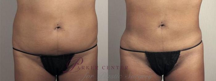 Brazilian Butt Lift Case 1340 Before & After Front | Paramus, NJ | Parker Center for Plastic Surgery