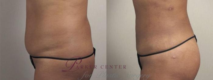Brazilian Butt Lift Case 1340 Before & After Left Side | Paramus, NJ | Parker Center for Plastic Surgery