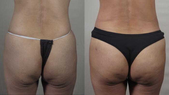 Brazilian Butt Lift Case 1497 Before & After Back | Paramus, New Jersey | Parker Center for Plastic Surgery